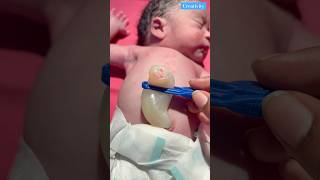 How Big Umbilical Cordmedical newbornbaby viralvideo [upl. by Hildegard]