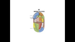 Infraorbital Nerve Block Injection [upl. by Fanestil]