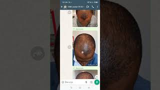 testimonio de Resultados del Foti POLIGONUM MULTIFLORUM para eliminar la alopecia CALVICIE [upl. by Ilujna]