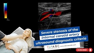 Severe stenosis of the internal carotid artery ultrasound diagnostic criteria [upl. by Elyc]