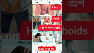 Piles or Hemorrhoids [upl. by Nhguavaj]