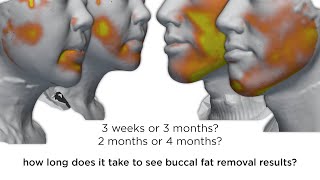 BUCCAL FAT REMOVAL  how long until I see my final result REAL Surgery Results in 3D over time [upl. by Chute]