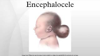 Encephalocele [upl. by Adlen]