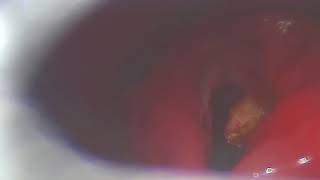 Bilateral Vocal cord palsy Post cordotomy partial arytenoidectomy [upl. by Jaret]