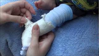 How to remove a fiberglass and plaster cast from an infant [upl. by Backer]