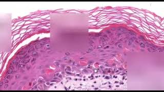 Erythema Multiforme Dermatopathology Easy learning [upl. by Mannie]