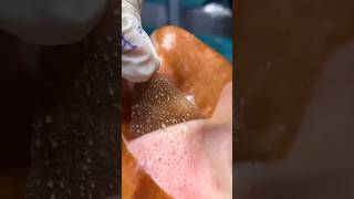 🔥Amazing Way To Remove Blackheads amp Whiteheads  Get Rid Of Blackheads 😍viralskincare ytshorts😱 [upl. by Nairadas]