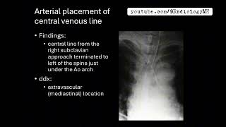 Cases 131 Arterial placement ofcentral venous line [upl. by Nyraf]