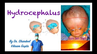 Hydrocephalus [upl. by Norbel]