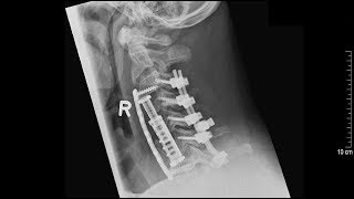 C5 Palsy Komplikation bei Operationen der HWS [upl. by Rois]