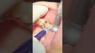 Deep tooth caries That tooth will be goner pt2dentist health teethcleaning 🦷beadrepair [upl. by Letsou]