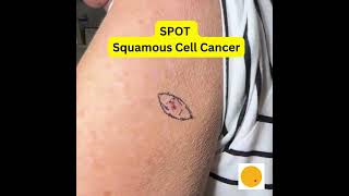 Squamous Cell Carcinoma arm Spot Skin Cancers [upl. by Nilknarf38]