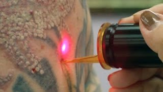 Laser Tattoo Removal  How a Tattoo is Removed [upl. by Joletta834]