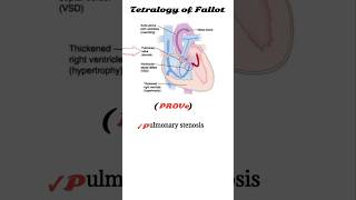 tetralogy of fallot mnemonic  TOF [upl. by Ceporah]