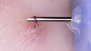 Ingrown hair removal [upl. by Artus]