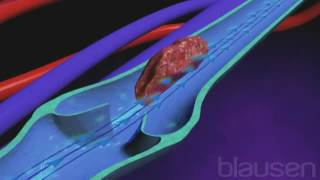 Phlébite symptômes causes et traitement de la thrombose veineuse [upl. by Thirza]