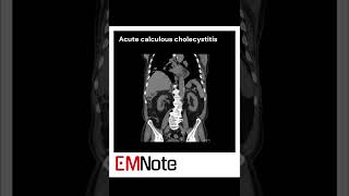 Acute Cholecystitis medical [upl. by Binni]