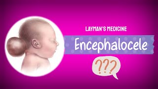 EncephaloceleNeural Tube defectCongenital disorders animated videoEnglish video [upl. by Akirat]