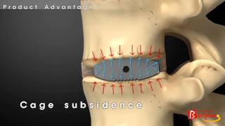 Bioflex Functional Cage SystemBiospine [upl. by Glennon]