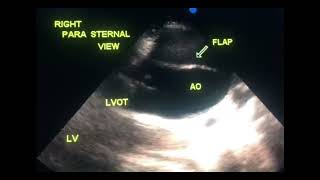 Asymptomatic dissection of aorta to drahmadmirdamadisiJSbA7GCDIDSLEpD [upl. by Hinkle]