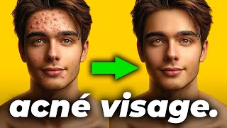 ❌ BOUTONS D’ACNÉ VISAGE  Comment en Finir Définitivement ✅ [upl. by Coulson853]