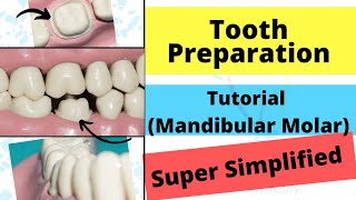 Mandibular Molar Crown Preparation Demonstration [upl. by Suertemed]