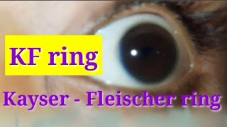 Kayser  Fleischer ring  Wilsons disease [upl. by Cesar]