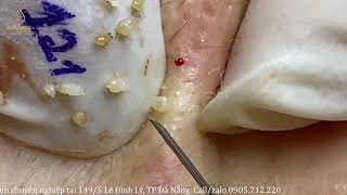 Pimples and Huge blackheads 121  Loan Nguyen [upl. by Berg936]