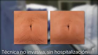 Radiofrecuencia Exilis Elite [upl. by Buote]