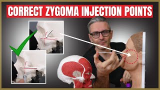 Injecting the Zygoma  Safety Advice amp Injection Points [upl. by Yoj]