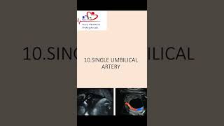 Single umbilical artery  What should we do SUA [upl. by Leahicm]