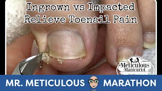 Ingrown Toenail and Impacted Toenail Relief and PreventionMrMeticulousMarathon [upl. by Haroved]