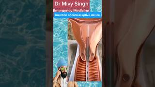 Inserting Contraceptive Device contraception contraceptives uterus [upl. by Angela]