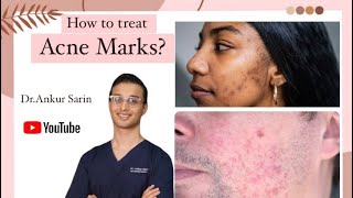 Acne Marks treatment  Acne treatment Dermatologist  Lasers and peels  Dr Ankur [upl. by Nedyah354]