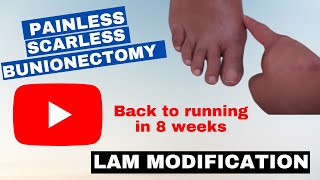 Lam Modification Painless  scarless bunionectomy [upl. by Sined]