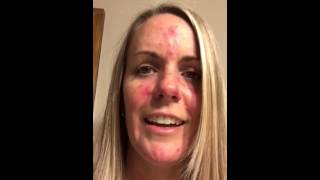 Rosacea update [upl. by Bael]