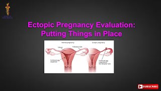 Ectopic Pregnancy Evaluation Putting Things in Place [upl. by Narol]