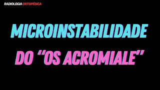 Os Acromiale com microinstabilidade [upl. by Annayar]