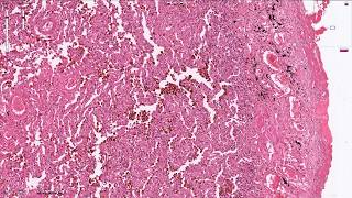 Chronic Pulmonary Congestion  Histopathology [upl. by Nahej]