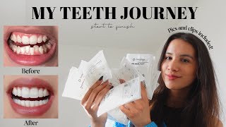 MY TEETH JOURNEY  Invisalign Composite Bonding Whitening  Answering All Your Questions [upl. by Latreese190]