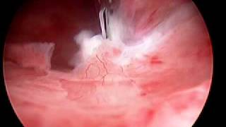 Hysteroscopic Morcellation of Myoma [upl. by Ravert]