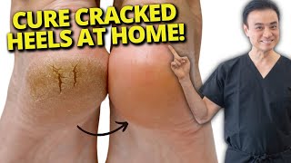 7 Cracked Heel Home Remedies That REALLY Work [upl. by Ibloc838]