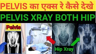 pelvis x ray kaise dekhe Techcpd pelvis x ray both hip कैसे देखे [upl. by Sukin871]