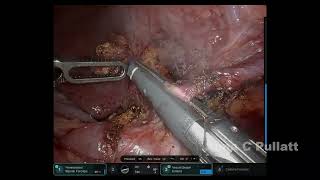 Median Arcuate Ligament Release [upl. by Eniksre]