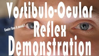 Caloric Testing COWS VestibuloOcular Reflex Hack  It Works [upl. by Denise]