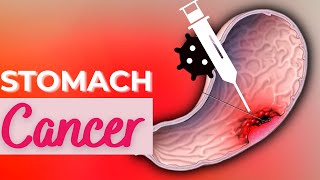 Stomach Cancer Causes Signs and Symptoms Diagnosis and Treatment [upl. by Sinne]