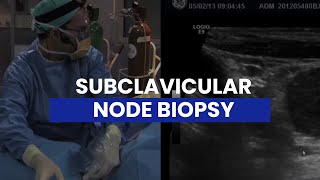 How to Perform a Subclavicular Node Biopsy [upl. by Kazim]