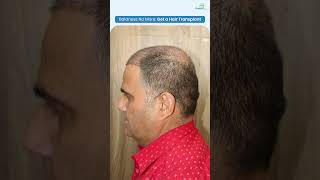 14 Days Later Manoj Gajurels Hair Transplant Results Revealed hairtransformation hairloss hair [upl. by Nnednarb]