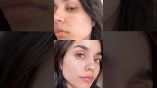 How I Reduced My Pigmentation In 2 weeks😍 [upl. by Hagood930]