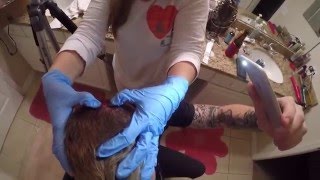 At Home Pilar Cyst Removal [upl. by Jorry]